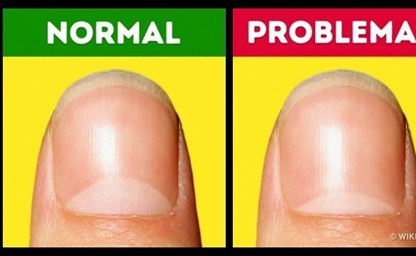 14 дефектов ногтей которые говорят о серьезных заболеваниях