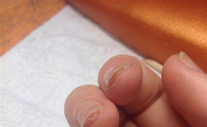 Что делать если трескается кожа на пальцах рук около ногтей