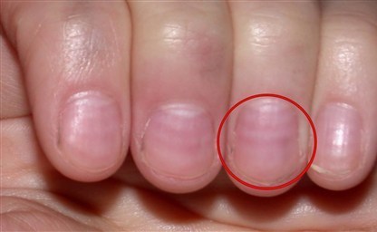 Полосы на ногтях какие бывают и почему появляются способы 