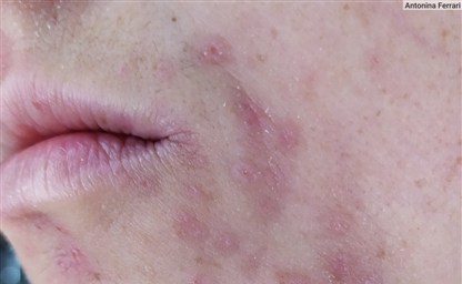 Аллергия на лице 115 фото симптомов описание характерных 