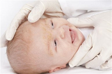 Корочки и шелушение на бровях у новорожденного ребенка 