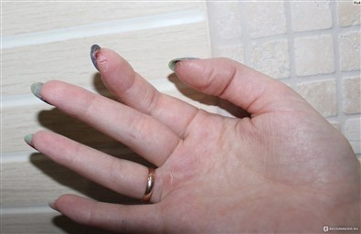 Ожог ногтевой пластины Что делать Преображение ногтей