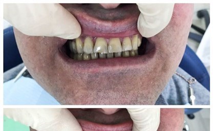 Как происходит изготовление съмных зубных протезов